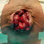 Emorroidi dr. Adolfo Renzi Proctologia Napoli sala operatoria