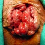 Emorroidi voluminoso prolasso dr. Adolfo Renzi Proctologia Napoli
