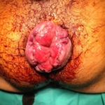 Prolasso muco emorroidario dr. Adolfo Renzi Proctologia Napoli