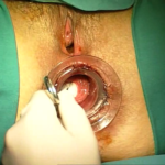 Transtar - dr. Adolfo Renzi 1