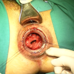 Transtar - dr. Adolfo Renzi 2