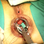 Transtar - dr. Adolfo Renzi 3