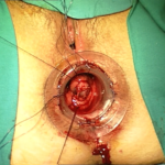 Transtar - dr. Adolfo Renzi 4