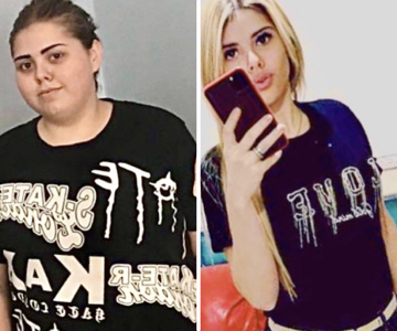 Foto pre e post bariatrica.005