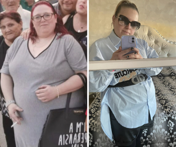Foto pre e post bariatrica.006