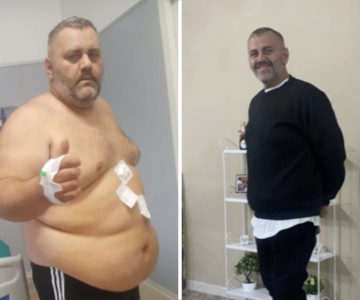 Foto pre e post bariatrica.007