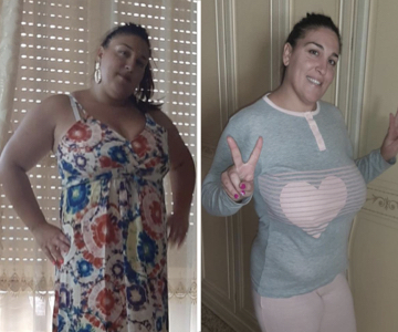 Foto pre e post bariatrica.012